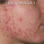 Ακμή στο πρόσωπο . Το skin Accumax είναι η καλύτερη εναλλακτική στα φάρμακα